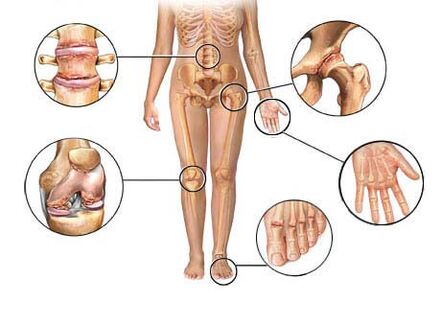 остеоартрит поражает несколько суставов